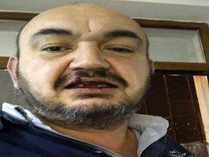 Uber Sürücüsünün Dişlerini Kırdılar