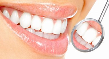 Diş beyazlatma kalıcı çözüm değil