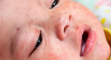 Kızamık vakalarında korkutan artış!