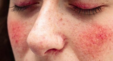 Sıcaklar 'gül hastalığı'na dikkat!