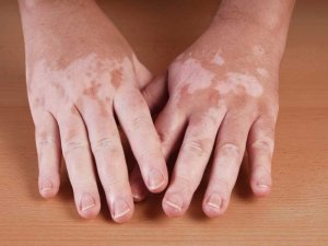 Vitiligo (Sinsi Beyazlık) Nedir? Nasıl Tedavi Edilir?