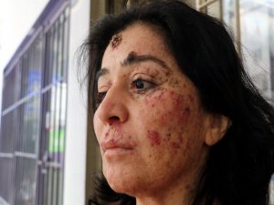 Yüzündeki Yaralar Hayatı Zindan Etti: "Deneylere Katılmak İstiyorum"