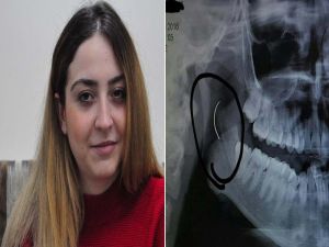 Boğazındaki İğneyle Tam 18 Yıl Yaşadı